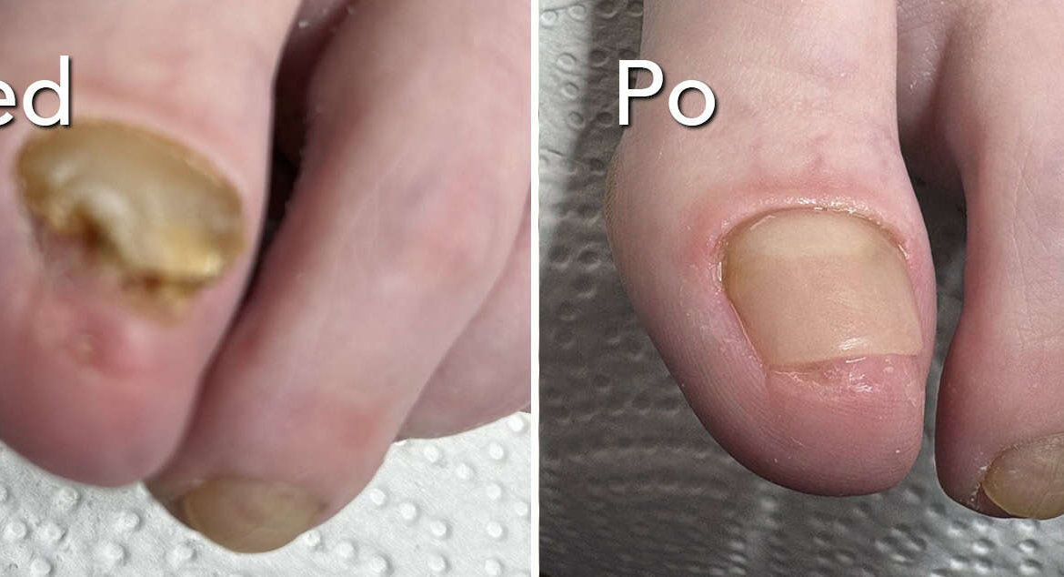 Zabieg rekonstrukcji płytki paznokcia