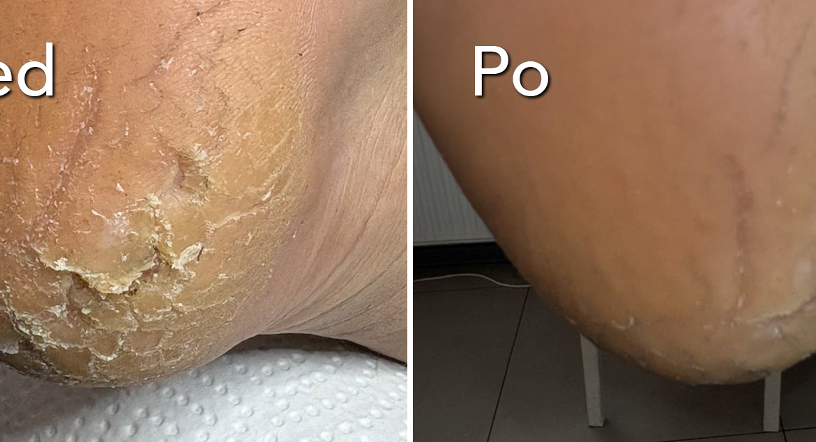 Problem z pękającymi piętami