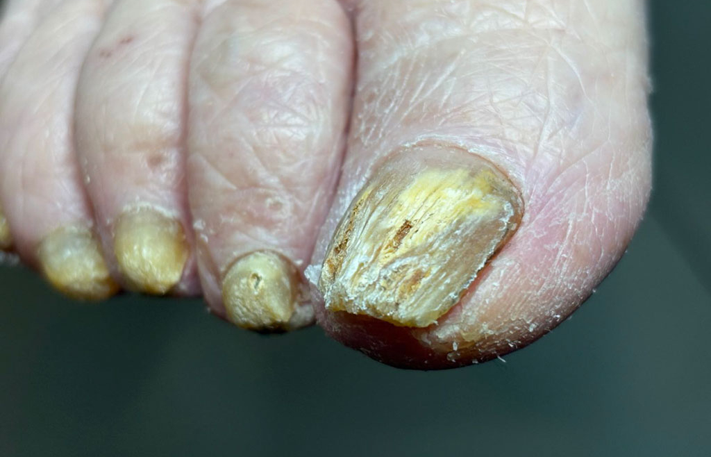 Grzybica paznokci – objawy i leczenie