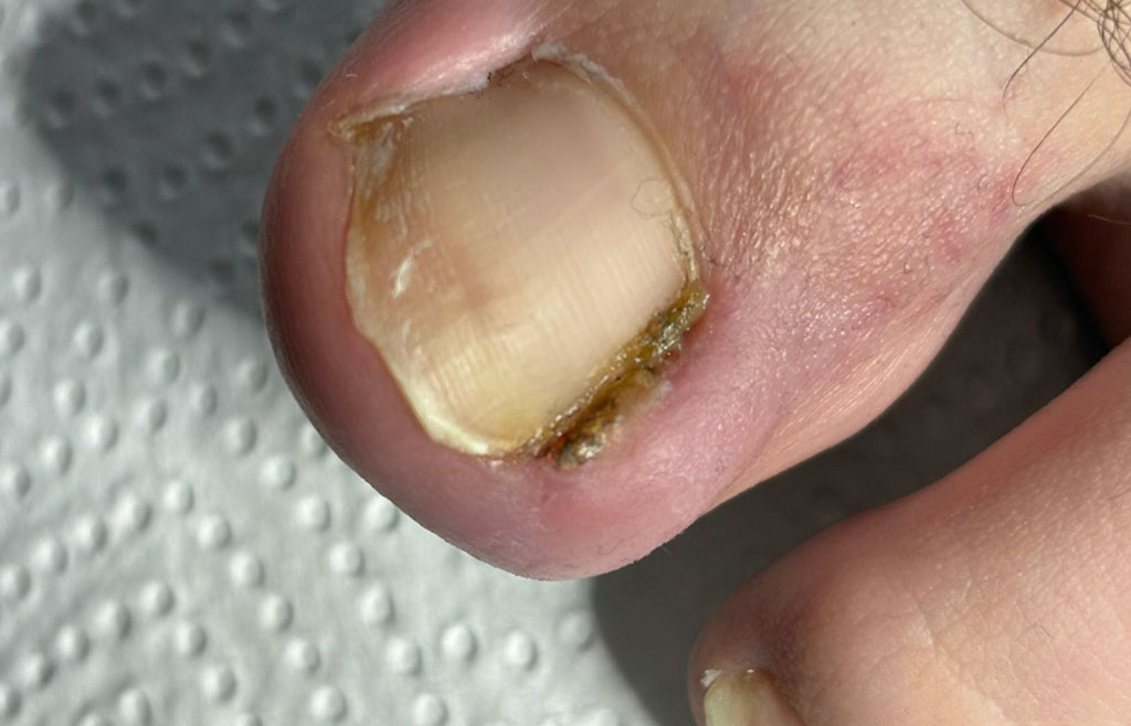 Co zrobić z wrastającym paznokciem?