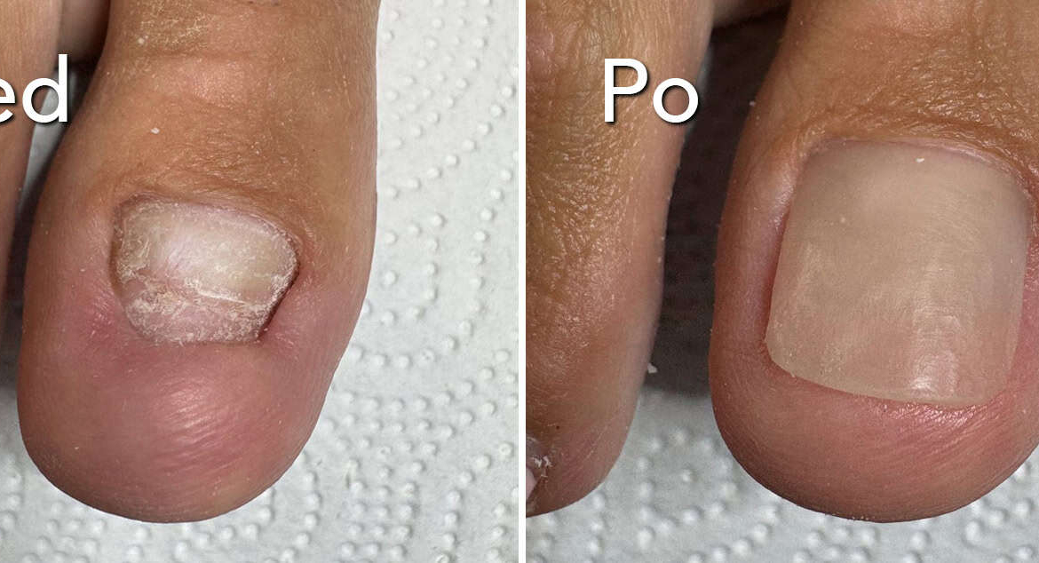 Rekonstrukcja paznokcia